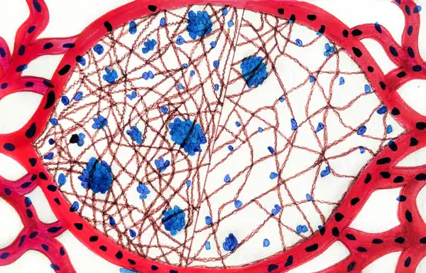 On the left - A fibrotic tissue which favours increased colonization and outgrowth of metastasising cells. On the right - A less fibrotic tissue, which does not favour as much persistence and colonization of metastasising cells (red - blood vessels; blue - metastasising cells; brown - collagen). © Sunaina Rao.