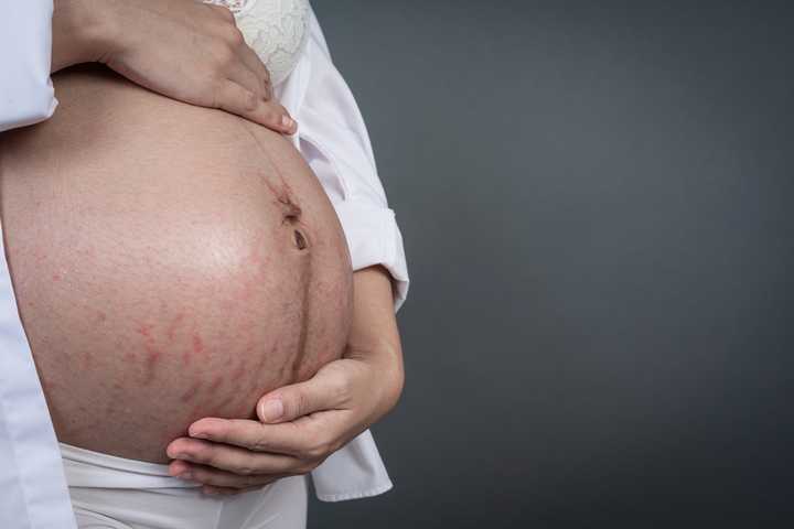 Stretch marks during pregnancy. Credit: [Freepik](https://www.freepik.com/free-photo/pregnant-woman-with-striped-belly_5219516.htm).