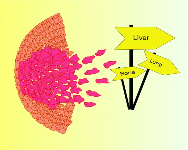 The 'soil and seed theory' applies to cancer cells. © Sunaina Rao.