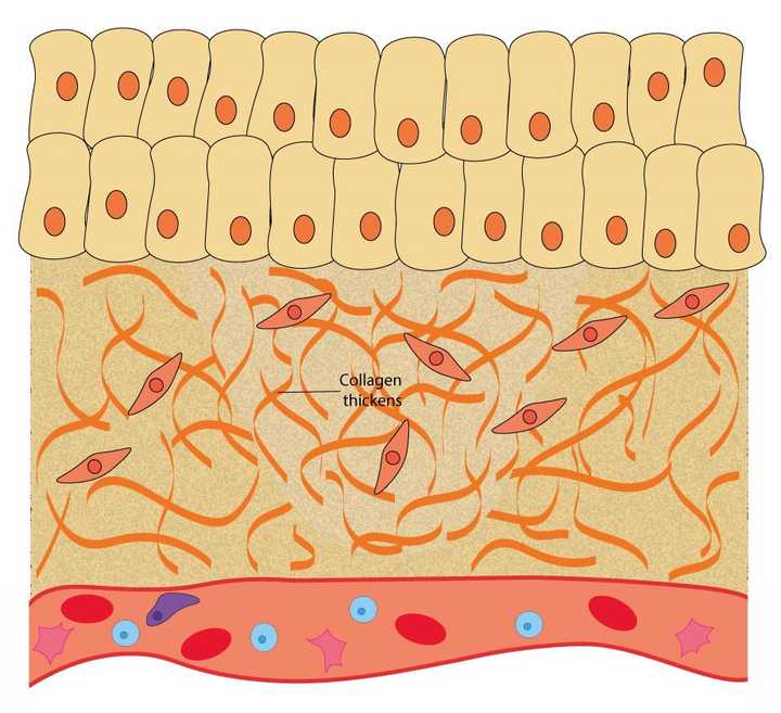 In the remodelling phase, the secreted collagen thickens, providing more strength to the tissue. © Sunaina Rao In the remodelling phase, the secreted collagen thickens, providing more strength to the tissue. © Sunaina Rao
