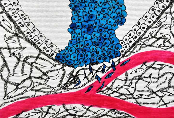 Once the cell load increases, they recruit blood vessels to their aid, escape from their tissue confines and move into the blood stream, searching for a more comfortable home. © Sunaina Rao. Tumour invasion