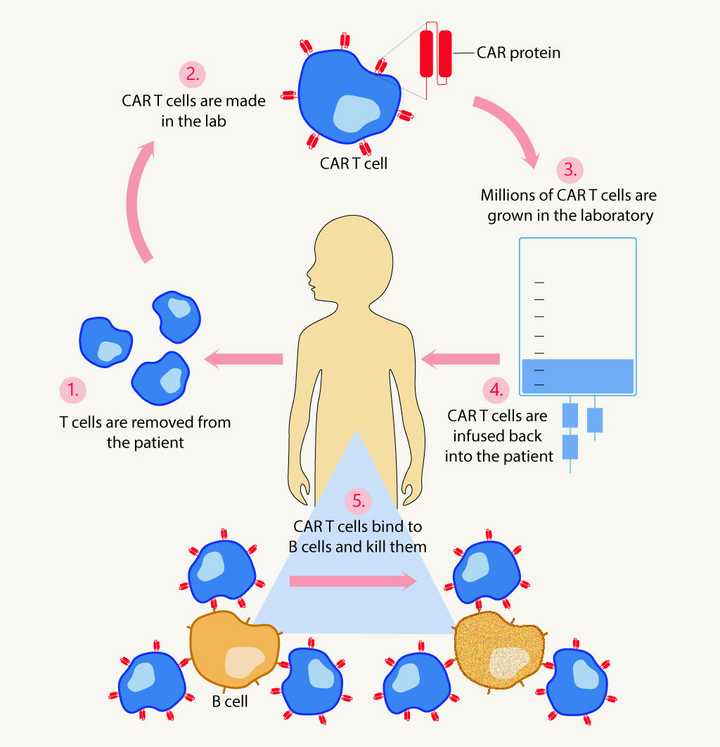 Steps involved in CAR T cell therapy: Step 1 – T cells are extracted from the patient. Step 2 – T cells are genetically modified so that they make a protein called the chimeric antigen receptor (CAR) protein on their cell surface. Step 3 – Millions of these CAR T cells are grown in the lab. Step 4 – These CAR T cells are infused back into the patient. Step 5 – CAR T cells specifically bind the B cells and kill them. © Sunaina Rao. Steps involved in CAR T cell therapy: Step 1 – T cells are extracted from the patient. Step 2 – T cells are genetically modified so that they make a protein called the chimeric antigen receptor (CAR) protein on their cell surface. Step 3 – Millions of these CAR T cells are grown in the lab. Step 4 – These CAR T cells are infused back into the patient. Step 5 – CAR T cells specifically bind the B cells and kill them. © Sunaina Rao.