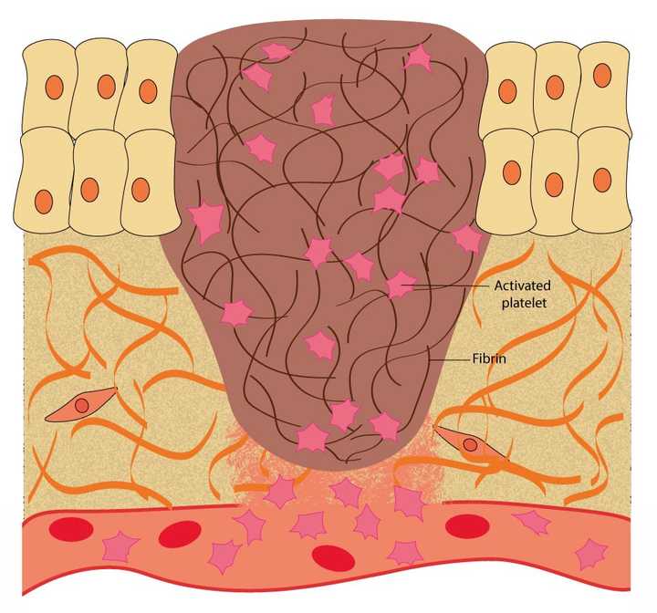 In the haemostasis phase, the blood oozing out of the blood vessels is blocked. This is achieved by the platelets, which help in the synthesis of a protein mesh made of fibrin. © Sunaina Rao In the haemostasis phase, the blood oozing out of the blood vessels is blocked. This is achieved by the platelets, which help in the synthesis of a protein mesh made of fibrin. © Sunaina Rao