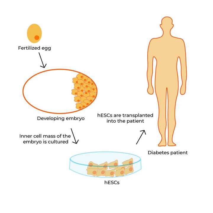 hESCs (derived from a fertilized egg) are cultured under laboratory conditions and transplanted into diabetic patients. © Sunaina Rao Stem cell replacement
