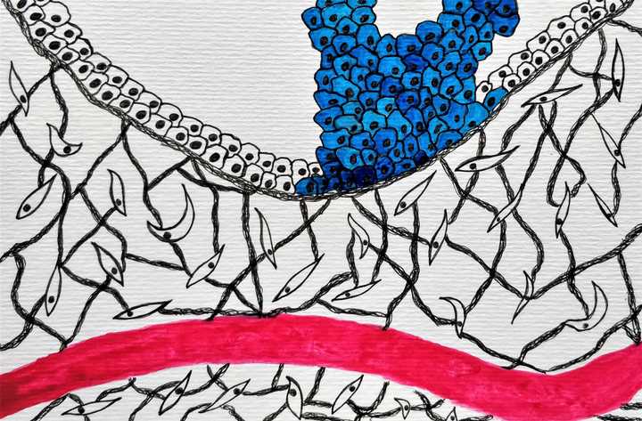 The tumour progresses by rampant, uncontrolled division of cells. © Sunaina Rao. Tumour progression