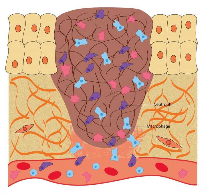 In the inflammatory phase, macrophages and neutrophils enter the wound area and kill any infectious agents like bacteria and fungi. © Sunaina Rao In the inflammatory phase, macrophages and neutrophils enter the wound area and kill any infectious agents like bacteria and fungi. © Sunaina Rao
