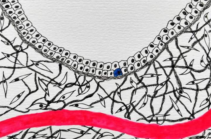 A tumour begins from that one cell that accumulates too many unrepaired mutations. Tumour cell in blue surrounded by a proteinaceous microenvironment. Blood vessel is red. © Sunaina Rao. The initiation of a tumour