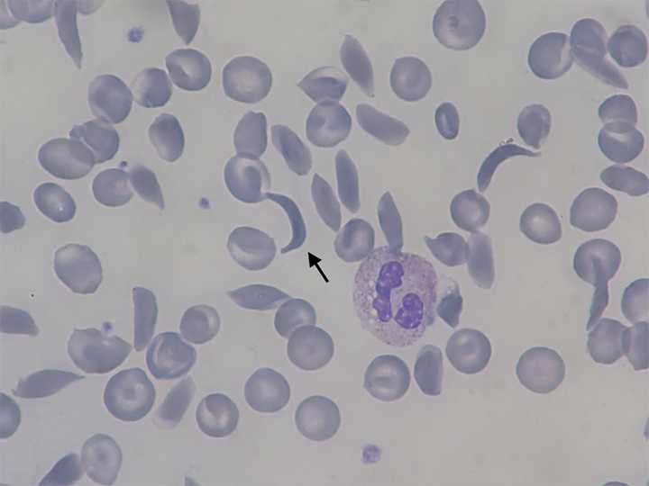Sickle shaped RBCs among normal RBCs found in sickle cell anemia. Credit: [Wikimedia](https://commons.wikimedia.org/wiki/File:Sickle-cell_smear_2015-09-10.jpg).