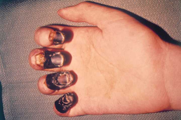Right hand of a plague patient displaying gangrene. Gangrene is one of the symptoms of plague. Credit: [Wikimedia](https://commons.wikimedia.org/wiki/File:Acral_gangrene_due_to_plague.jpg).